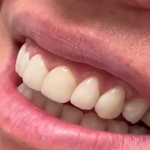 faccette dentali