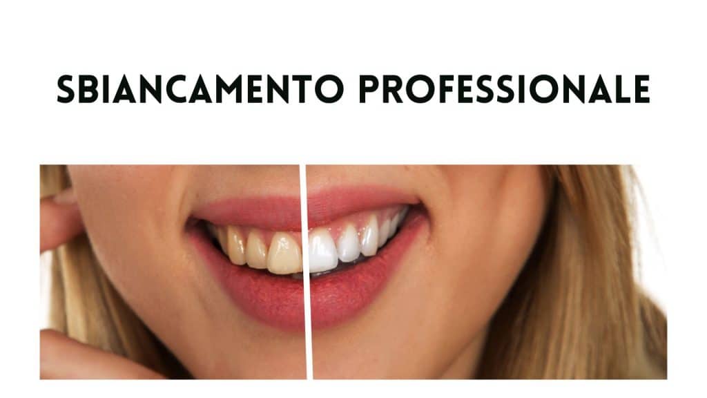 sbiancamento-professionale